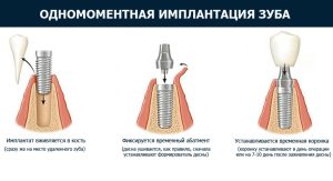 Преимущества и минусы одномоментной имплантации